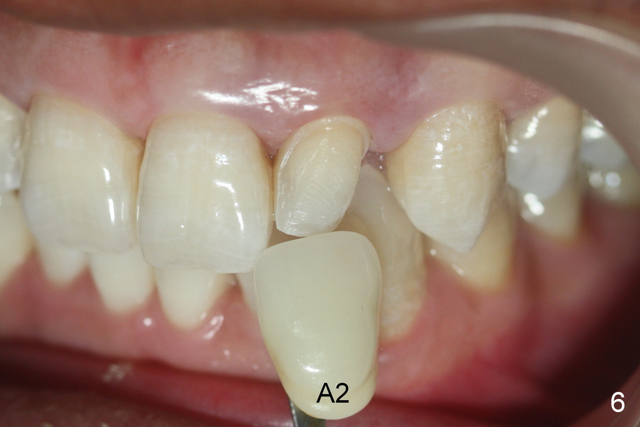 Occlusal Consideration for Peg Lateraals and Veneers, Duluth (Atlanta